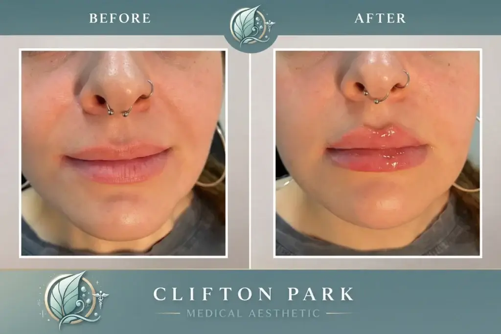 Before and after lip filler treatment results at Clifton Park Medical Aesthetics showing enhanced lip volume and definition.