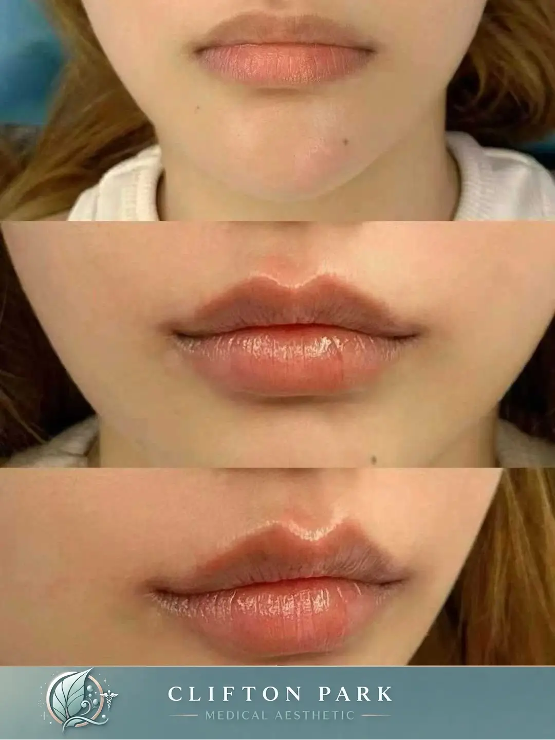 Three Images of before and after lip filler