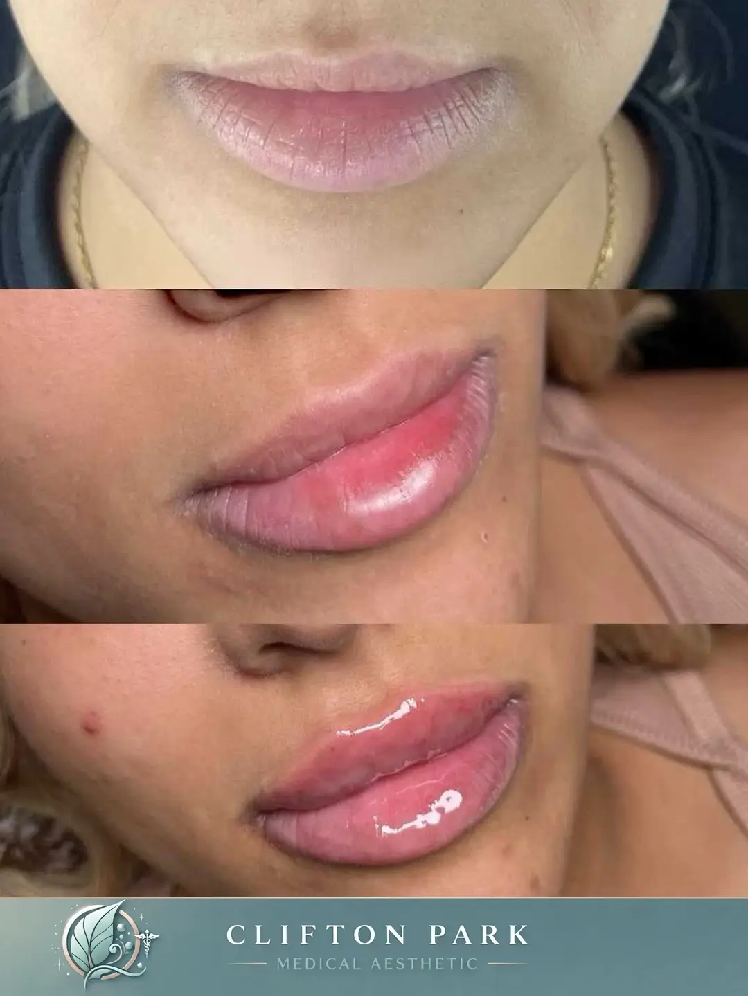 Three Images of before and after lip filler