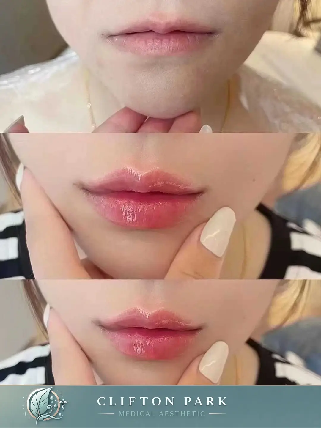 Three Images of before and after lip filler